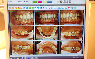口腔内カラー写真