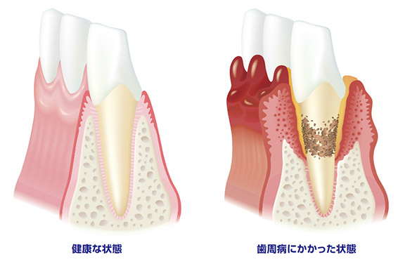 歯周病